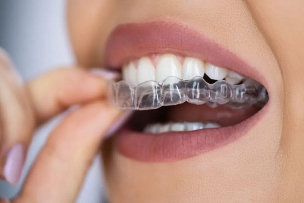 The Benefits of Clear Aligners for a Straighter and Healthier Smile Clear Aligners