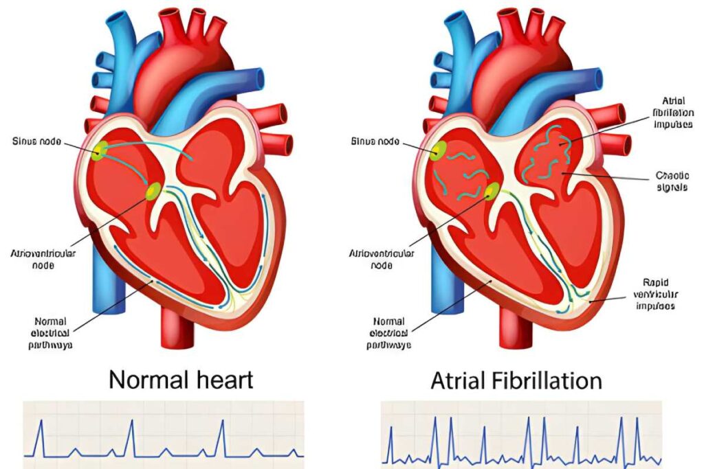 Atrial Fibrillation