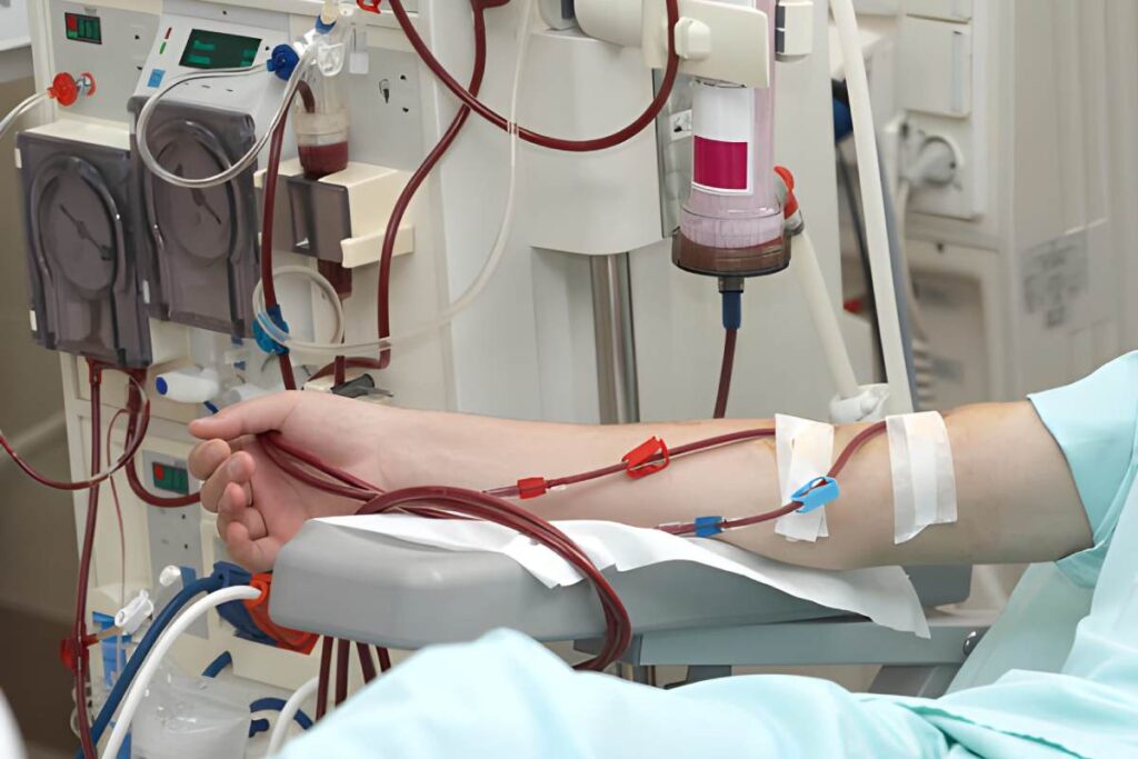 Dialysis Explained