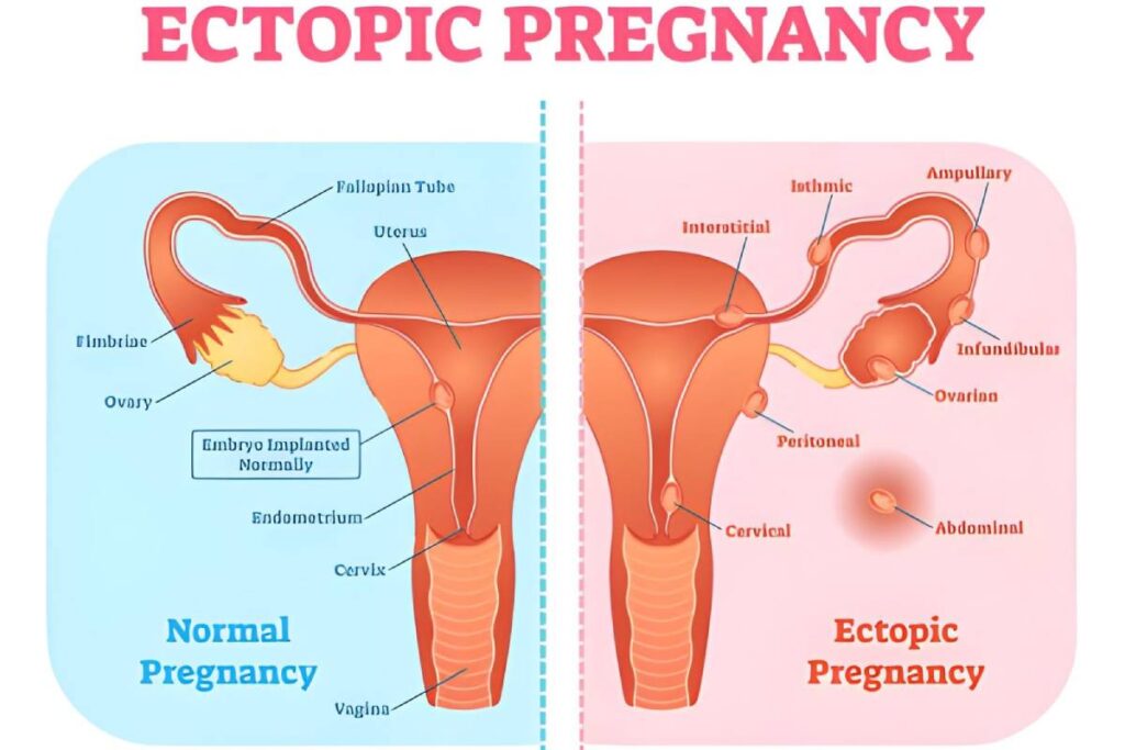 Ectopic Pregnancy