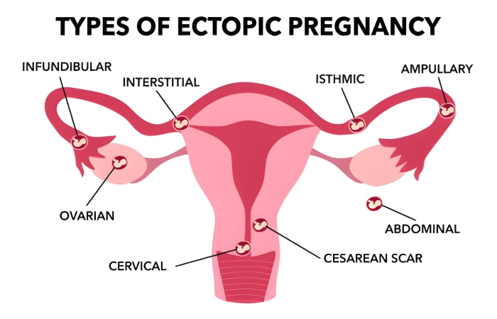 Symptoms of an Ectopic Pregnancy