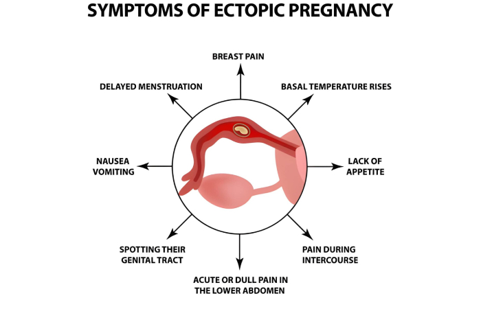 When Do Ectopic Pregnancy Symptoms Start